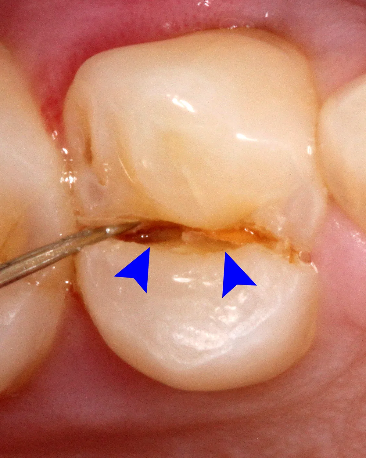 Close-up of a cracked back tooth, with arrows marking the crack line running across the crown