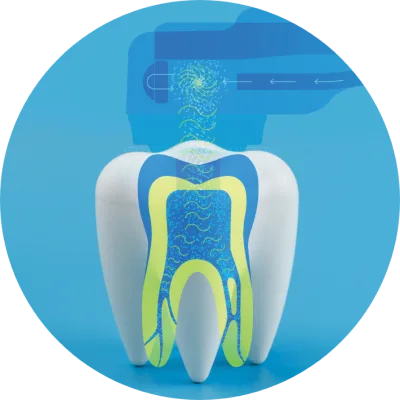 Diagram showing GentleWave Multisonic Ultracleaning technology cleaning the full root canal system